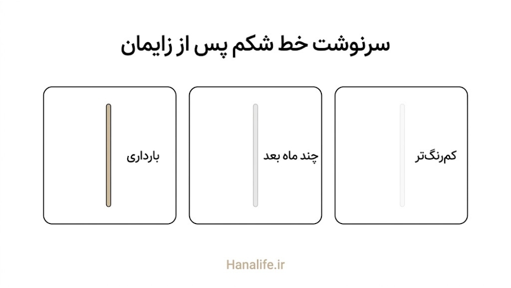 سه مرحله کمرنگشدن خط تیره شکم پس از زایمان بهصورت پانلهای خطی — لینیا نیگرا — هانالایف