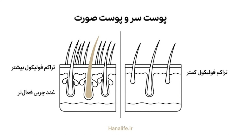 مقایسه برش عرضی پوست سر و پوست صورت با تراکم متفاوت فولیکول و غدد چربی — تفاوت پوست سر — هانالایف