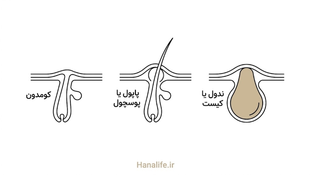 برش‌نگاری فولیکول در سه مرحله از کومدون تا ندول — طبقه‌بندی آکنه — هانالایف