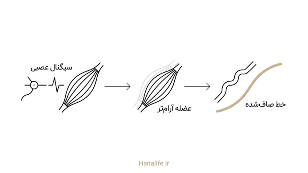 توالی اثر بوتاکس روی عضله تا صافی خط — فرق بوتاکس و فیلر — هانالایف