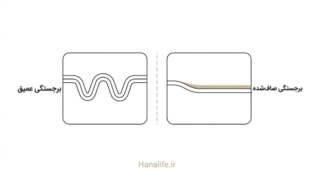 مقایسه rete ridges عمیق در پوست جوان و صاف‌شده در پوست مسن — هانالایف