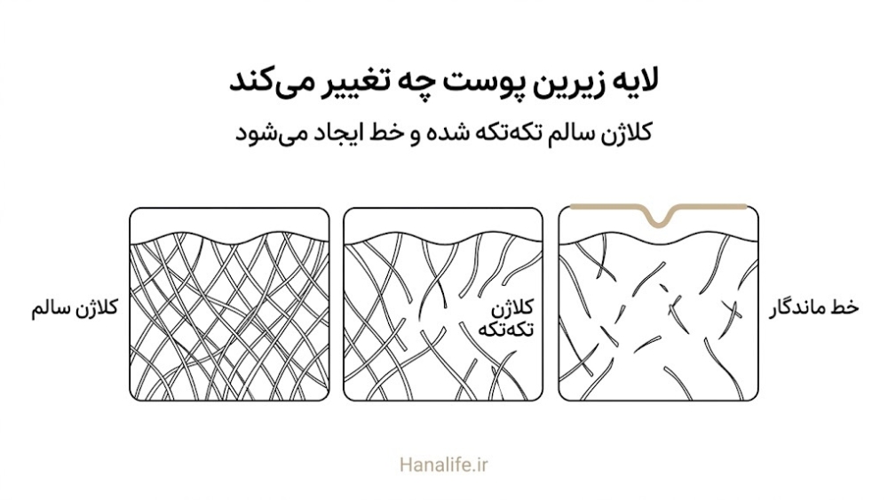مقطع پوست با الیاف کلاژن سالم و تکه‌تکه‌شده که به خط ماندگار می‌رسد — چروک استاتیک — هانالایف