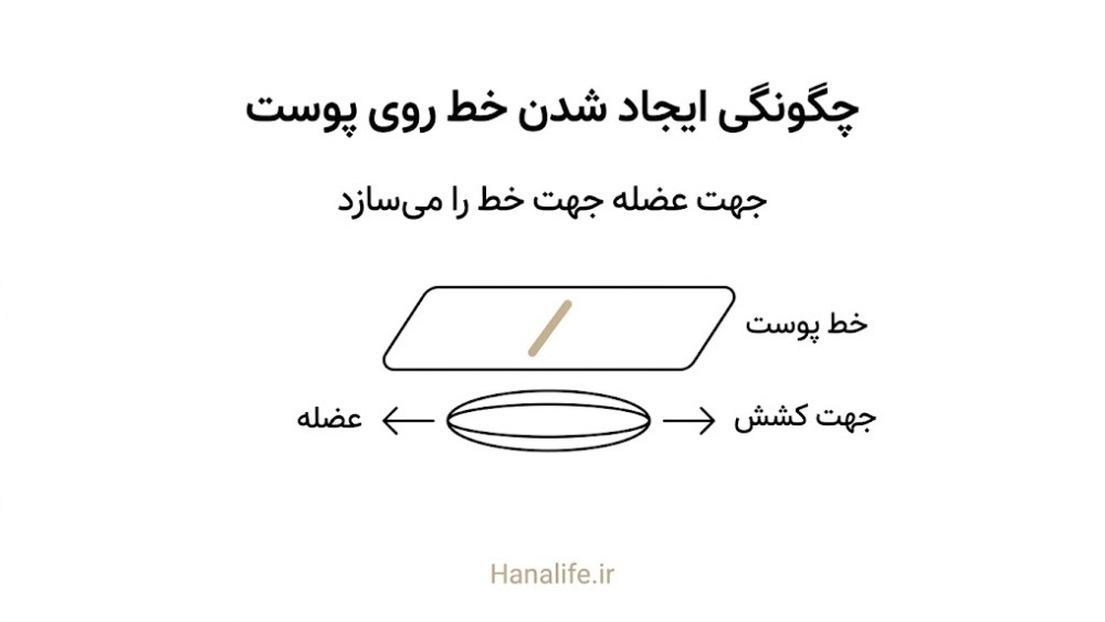 دیاگرام جهت کشش عضله عمود بر جهت خط اخم دینامیک روی پوست صورت در تصویر آموزشی — هانالایف