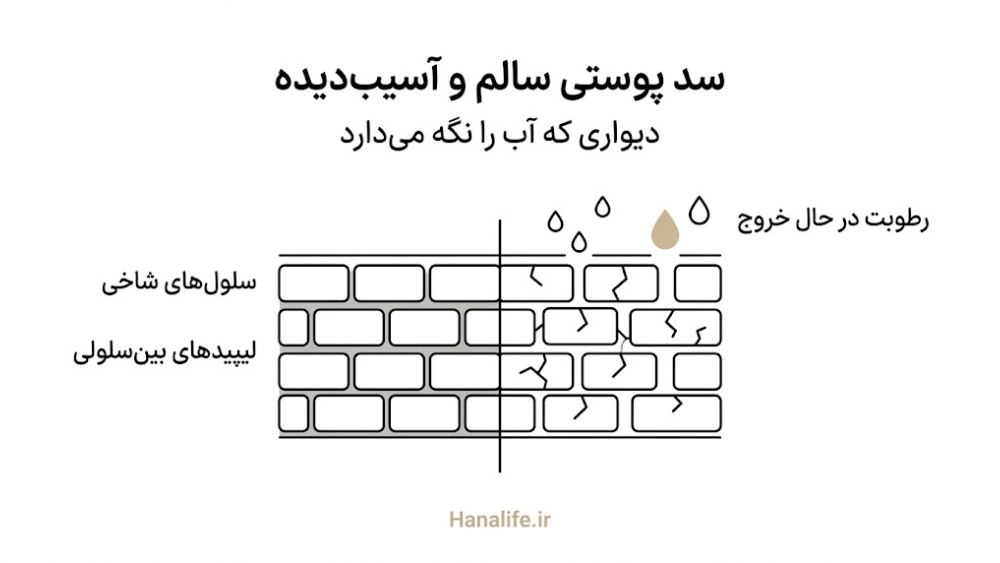 مقایسه سد پوستی سالم و آسیبدیده با نشت رطوبت — اگزما سد پوستی — هانالایف