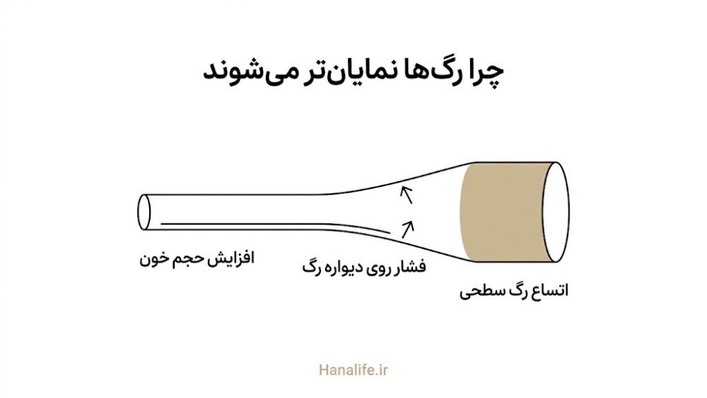 افزایش حجم خون بارداری که دیواره رگ سطحی پوست را متسع می‌کند — استروژن و پوست — هانالایف