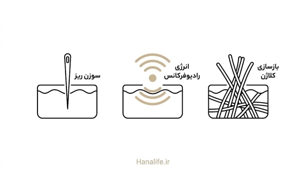 توالی سه‌مرحله‌ای سوزن ریز، انرژی رادیوفرکانس و بازسازی کلاژن در روش RF میکرونیدلینگ منافذ