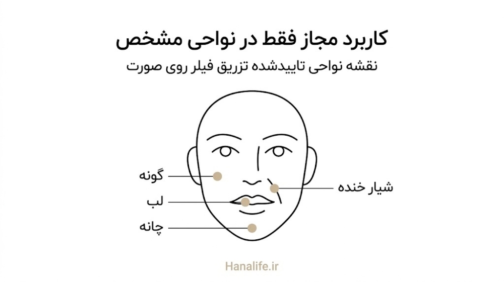 نقشه نواحی تاییدشده برای تزریق ژل صورت شامل لب، گونه، چانه، پشت دست و شیار خنده روی صورت — هانالایف
