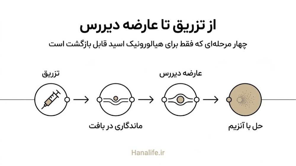 مسیر زمانی از لحظه تزریق ژل صورت تا بروز عارضه دیررس و تلاش برای حل شدن با آنزیم — هانالایف