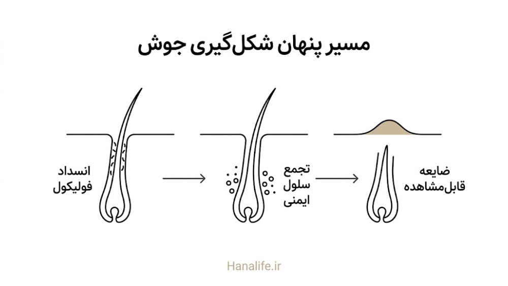 مراحل شکل‌گیری آکنه در فولیکول پیش از دیده‌شدن جوش روی پوست — هانالایف