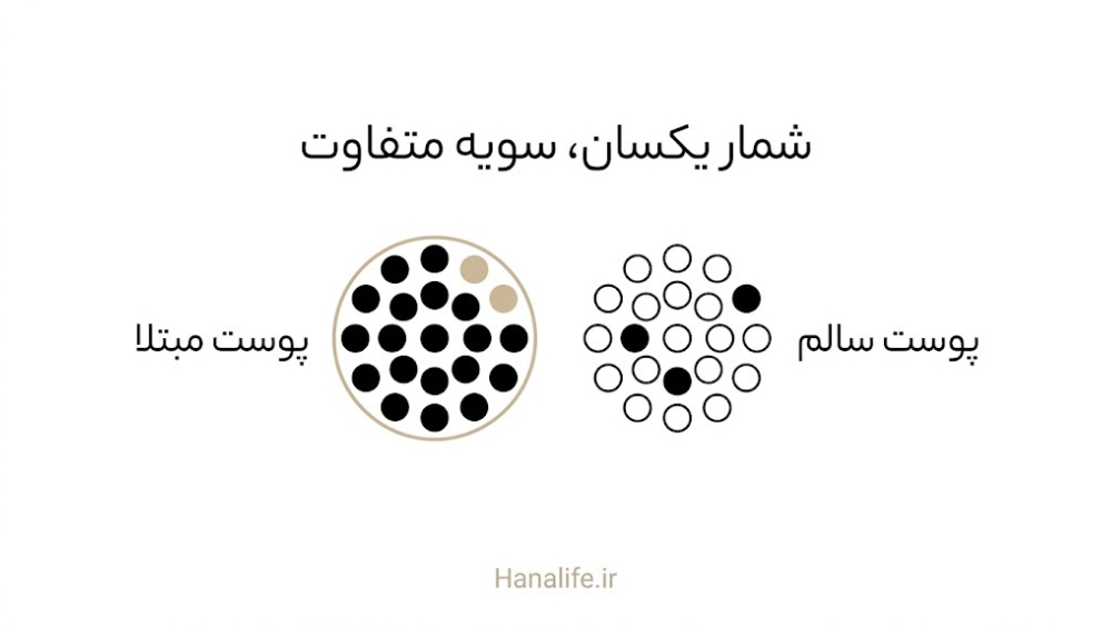 مقایسه ترکیب سویه باکتری آکنه در پوست مبتلا و پوست سالم با شمار یکسان — هانالایف