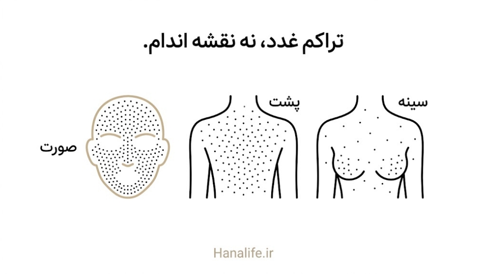  تراکم غدد چربی در صورت، پشت و سینه که واقعاً محل بروز آکنه را تعیین می‌کند — هانالایف