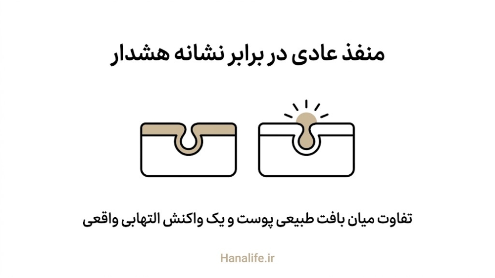 مقایسه بصری بافت عادی و آرام منفذ در برابر نشانههای التهابی واقعی پوست — نشانههای هشدار منافذ باز — هانالایف