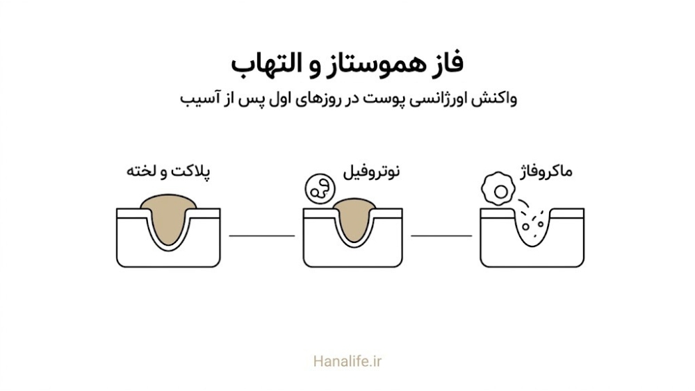 نمودار مراحل هموستاز و التهاب در ترمیم زخم پوست با پلاکت و ماکروفاژ — مراحل بهبود — هانالایف