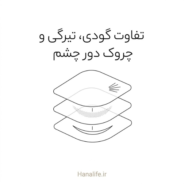 سه صفحه شفاف روی ناحیه چشم، هرکدام با یک نشان برای تفاوت گودی، تیرگی و چروک — گودی زیر چشم — هانالایف