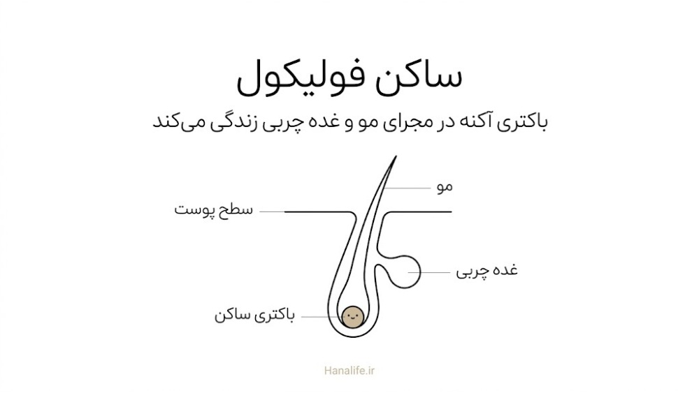 برش فولیکول مو با غده چربی و باکتری ساکن در مجرای آن؛ جایگاه کوتی‌باکتریوم آکنس در پوست