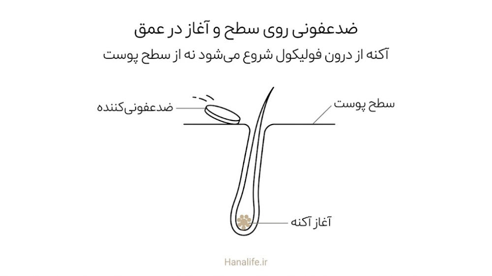 پاک‌کردن سطح پوست با ضدعفونی‌کننده در برابر آغاز آکنه در عمق فولیکول با تجمع کراتین و سبوم