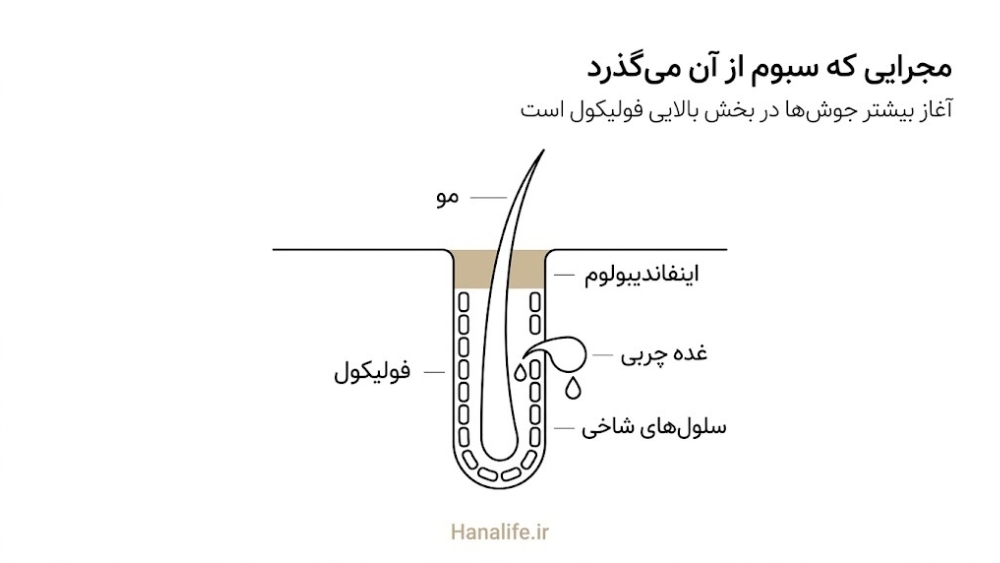 برش ساده فولیکول مو با غده چربی، سبوم و سلول‌های شاخی دیواره؛ محل آغاز میکروکومدون در بخش بالایی