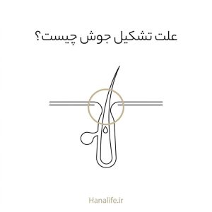 مجرای باریک فولیکول با دیوارههای نزدیکشونده و قطره سبوم — علت تشکیل جوش — هانالایف