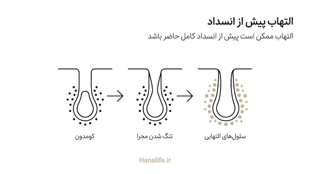  سه مرحله فولیکول با سلول‌های التهابی اطراف دیواره، تنگ شدن مجرا و شکل‌گیری کومدون