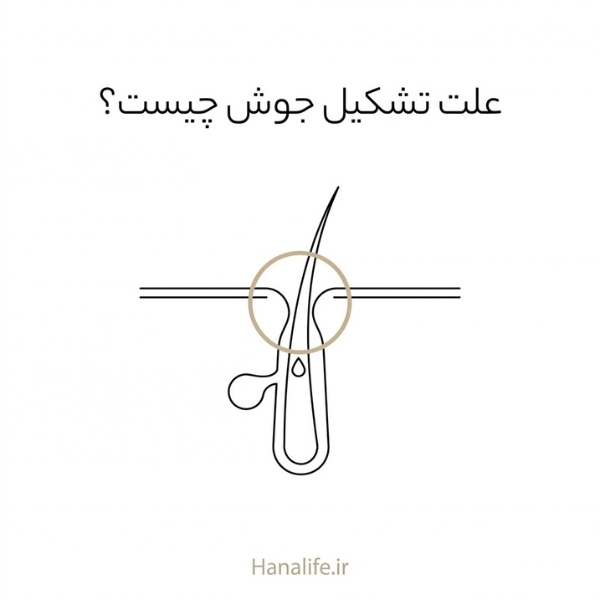 مجرای باریک فولیکول با دیواره‌های نزدیک‌شونده و قطره سبوم — علت تشکیل جوش — هانالایف
