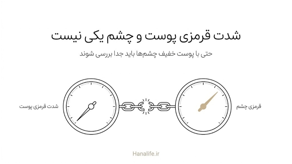 دو شاخص مستقل شدت پوست و چشم با زنجیر گسسته میانشان؛ توضیح بررسی جداگانه روزاسه چشمی