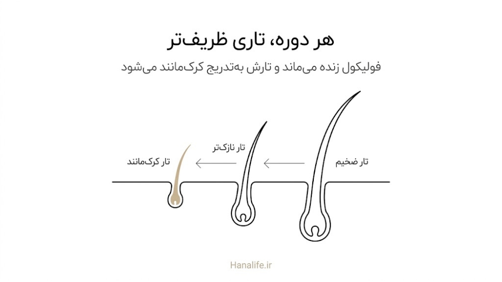  مراحل ظریف شدن تار مو در یک فولیکول از تار ضخیم تا کرک‌مانند در آلوپسی آندروژنیک