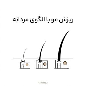 سه فولیکول مو شبیه کارگاه‌هایی کوچک‌تر با تارهایی ظریف‌تر — ریزش مو ارثی — هانالایف
