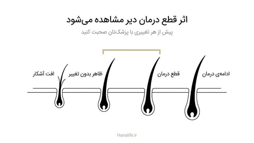 خط زمانی پس از قطع درمان ریزش مو با ظاهر بدون تغییر در ماه‌های اول و افت آشکار بعدتر
