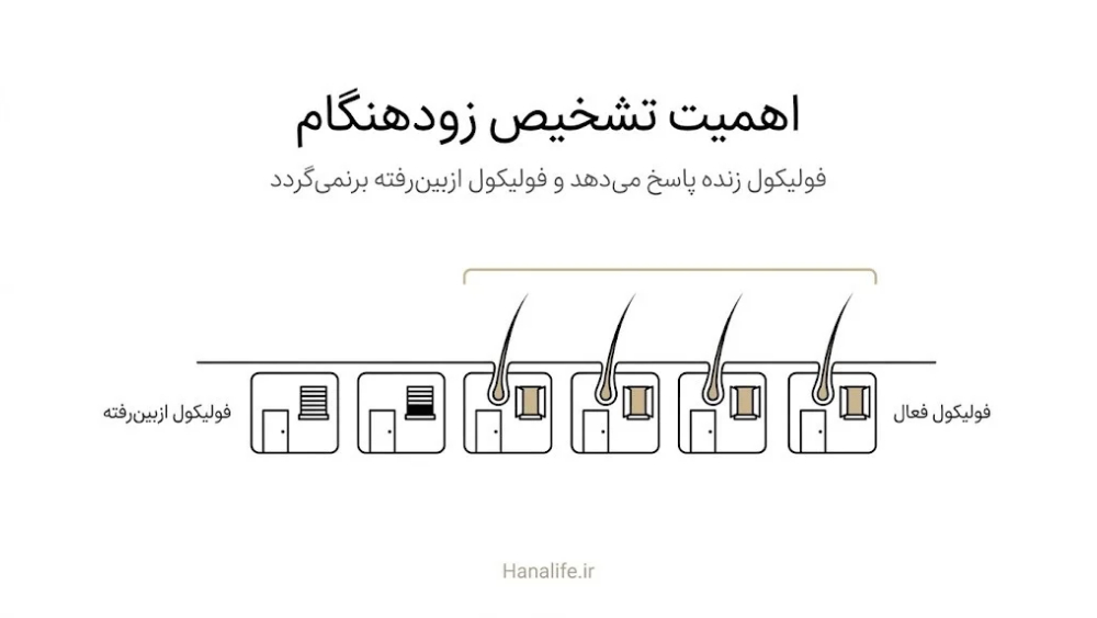  ردیف فولیکول‌های فعال مو در کنار فولیکول ازبین‌رفته و اهمیت مراجعه زودتر به پزشک در ریزش مو