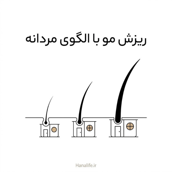 سه فولیکول مو شبیه کارگاه‌هایی کوچک‌تر با تارهایی ظریف‌تر — ریزش مو ارثی — هانالایف