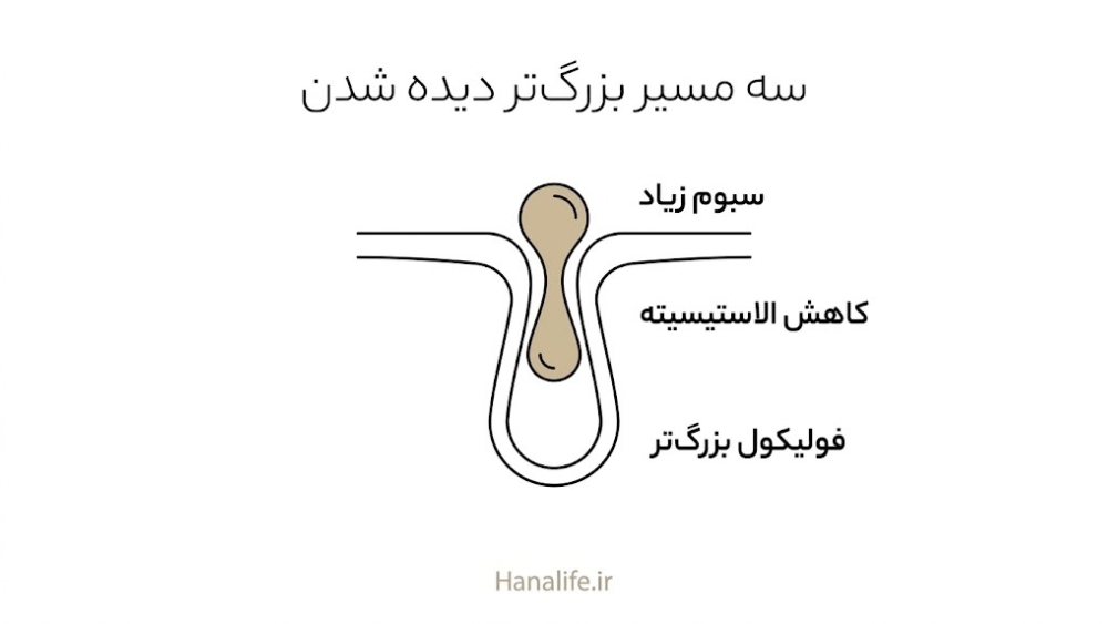 برش یک منفذ پوست با سه مسیر سبوم زیاد، کاهش الاستیسیته و فولیکول بزرگ‌تر در منافذ باز پوست