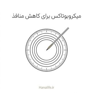سوزن ظریف و علامت‌های اندازه‌گیری دور یک منفذ پوست، نماد دقت — میکروبوتاکس منافذ — هانالایف