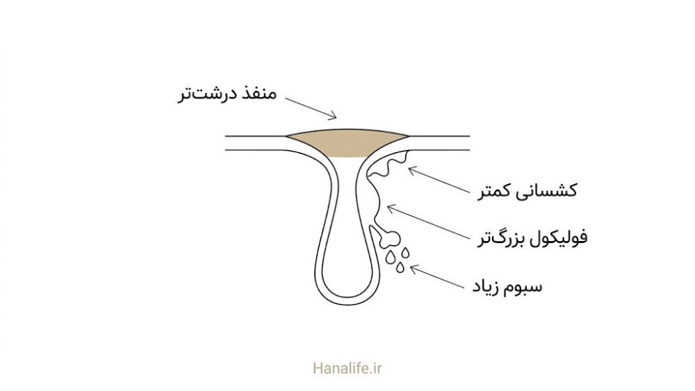 برش مقطع یک منفذ با سه علت درشت‌تر دیده شدن: سبوم زیاد، کشسانی کمتر و فولیکول بزرگ‌تر در منافذ باز پوست