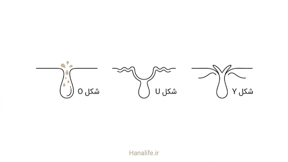  برش پوست با سه شکل منفذ O، U و Y برای شناخت نوع منافذ باز و انتخاب محصول مناسب هر نوع