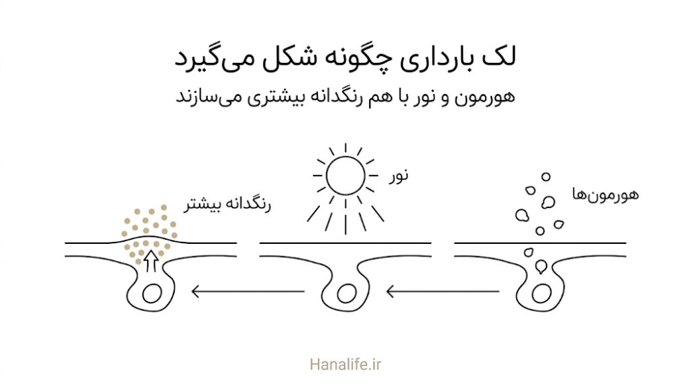 مراحل اثر هورمون‌ها و نور بر ملانوسیت و افزایش رنگدانه در پوست؛ سازوکار لک بارداری