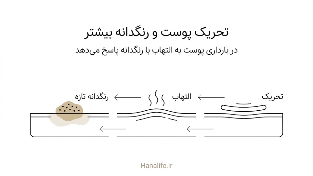 سه مرحله تحریک پوست، التهاب و شکل‌گیری رنگدانه تازه روی لک؛ خطر درمان تهاجمی لک بارداری