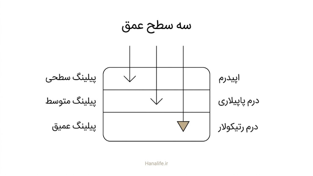 مقطع پوست با سه سطح پیلینگ سطحی، متوسط و عمیق که به اپیدرم، درم پاپیلاری و درم رتیکولار میرسند