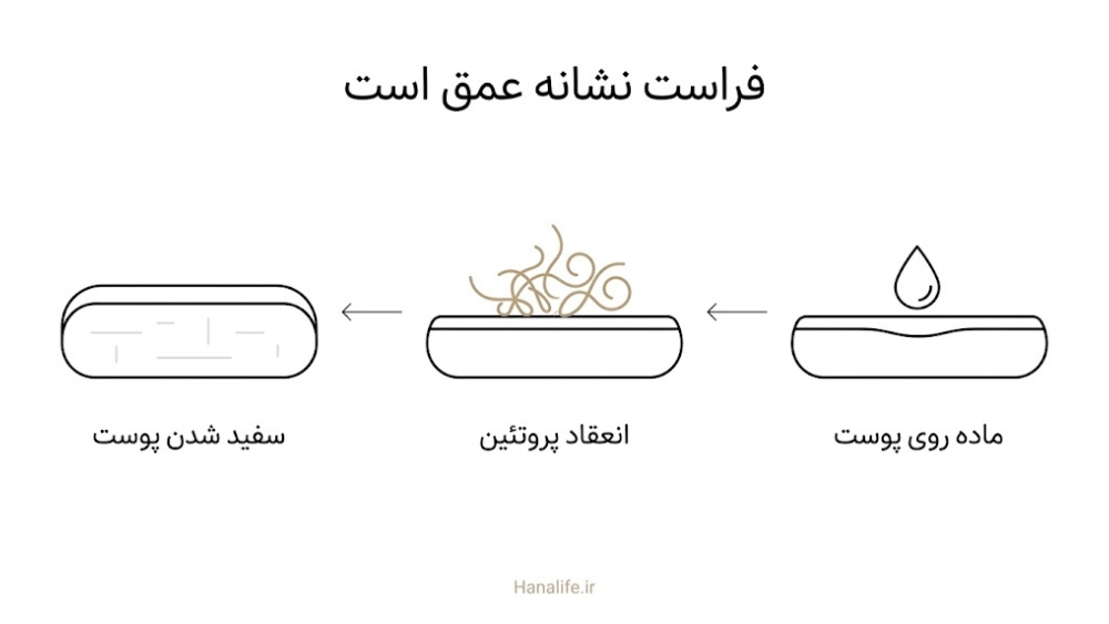 سه مرحله فراست: ماده روی پوست، انعقاد پروتئین و سفید شدن پوست بهعنوان نشانه عمق پیلینگ شیمیایی