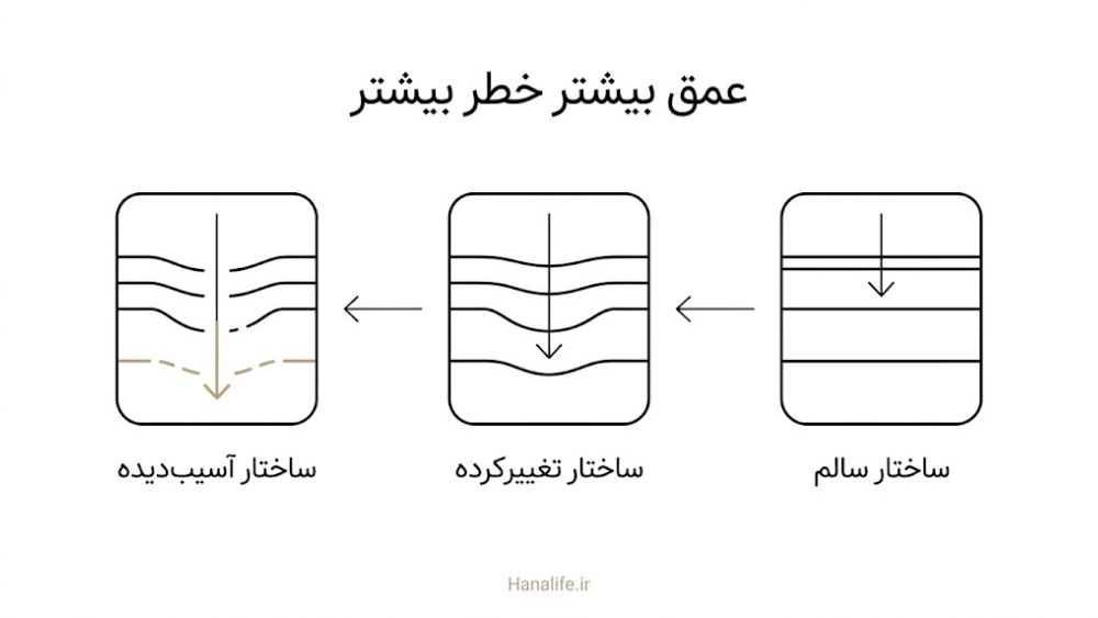سه مرحله افزایش عمق پیلینگ روی مقطع پوست و تغییر ساختار لایهها، مرتبط با عوارض پیلینگ در پوست تیره