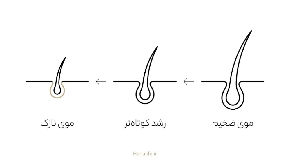  سه مرحله کوچک‌شدگی فولیکول مو در الگوی ارثی ریزش مو، از موی ضخیم و دوره رشد بلند تا موی نازک