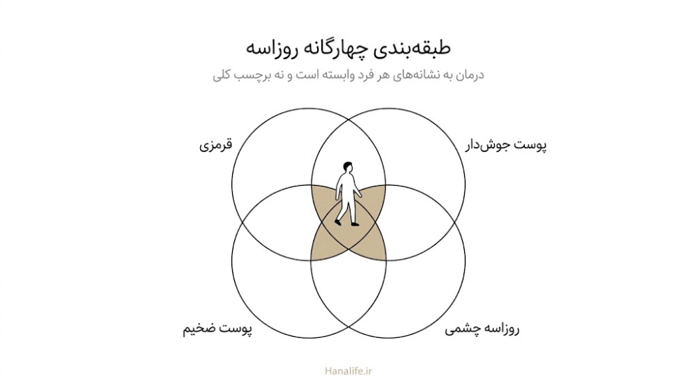  چهار دایره هم‌پوشان با سیلوئتی در محل تلاقی؛ محدودیت طبقه‌بندی قدیمی و انواع روزاسه