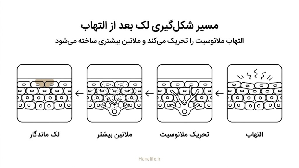 زنجیره التهاب، تحریک ملانوسیت، افزایش ملانین و ماندگاری لک پس از التهاب (PIH) در اپیدرم