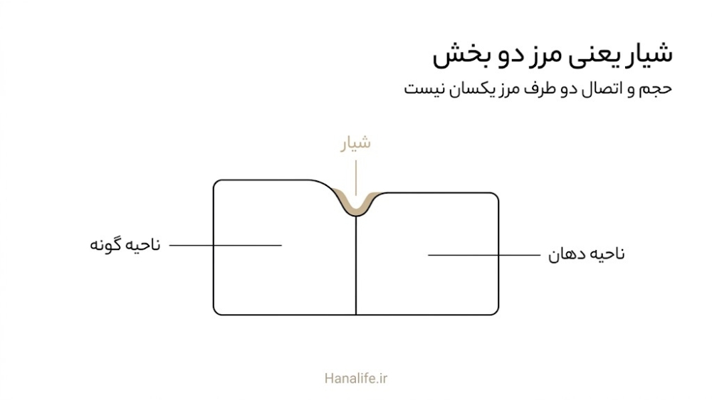 برش ساده‌ی دو بخش چربی گونه و ناحیه‌ی دهان که در مرز شیار بینی‌ـ‌لبی به هم می‌رسند و توضیح خط لبخند