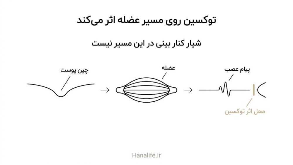  مسیر سه‌مرحله‌ای پیام عصب، انقباض عضله و چین پوست با نشان دادن محل اثر توکسین در بوتاکس خط خنده