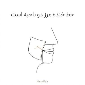 طرح خطی دو ناحیه‌ی صورت که در یک درز به هم می‌رسند، توضیح تصویری خط خنده و شیار کنار بینی — خط خنده — هانالایف