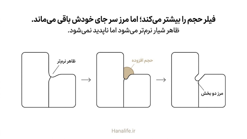  برش ساده‌ی مرز دو بخش چربی با حجم افزوده‌ی فیلر خط خنده که ظاهر شیار را نرم‌تر می‌کند